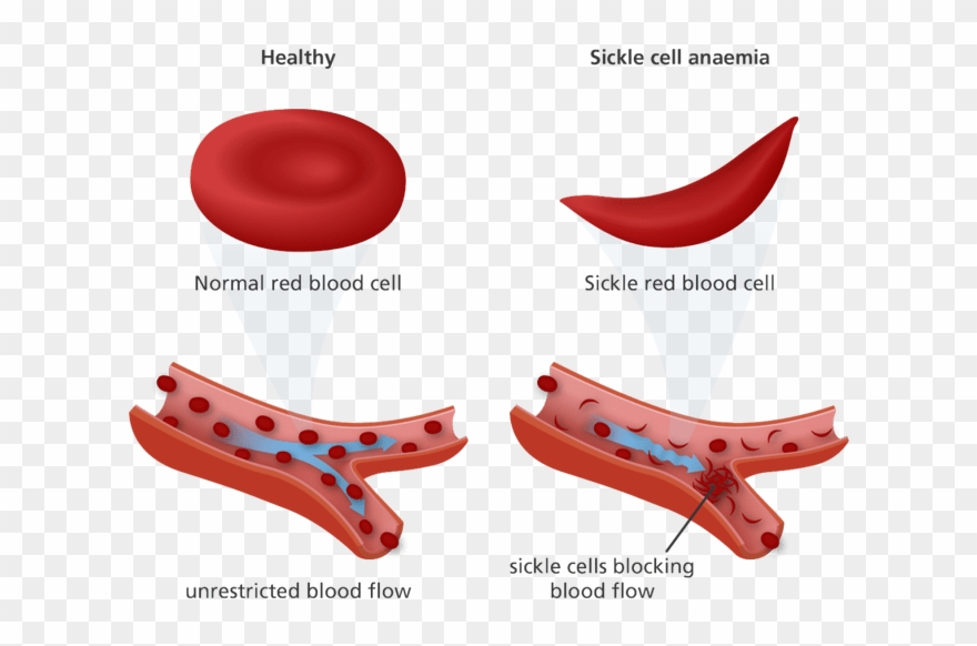 Cotton Clipart White Blood Cell - Normal Red Blood Cell And Sickle Cell - Png Download