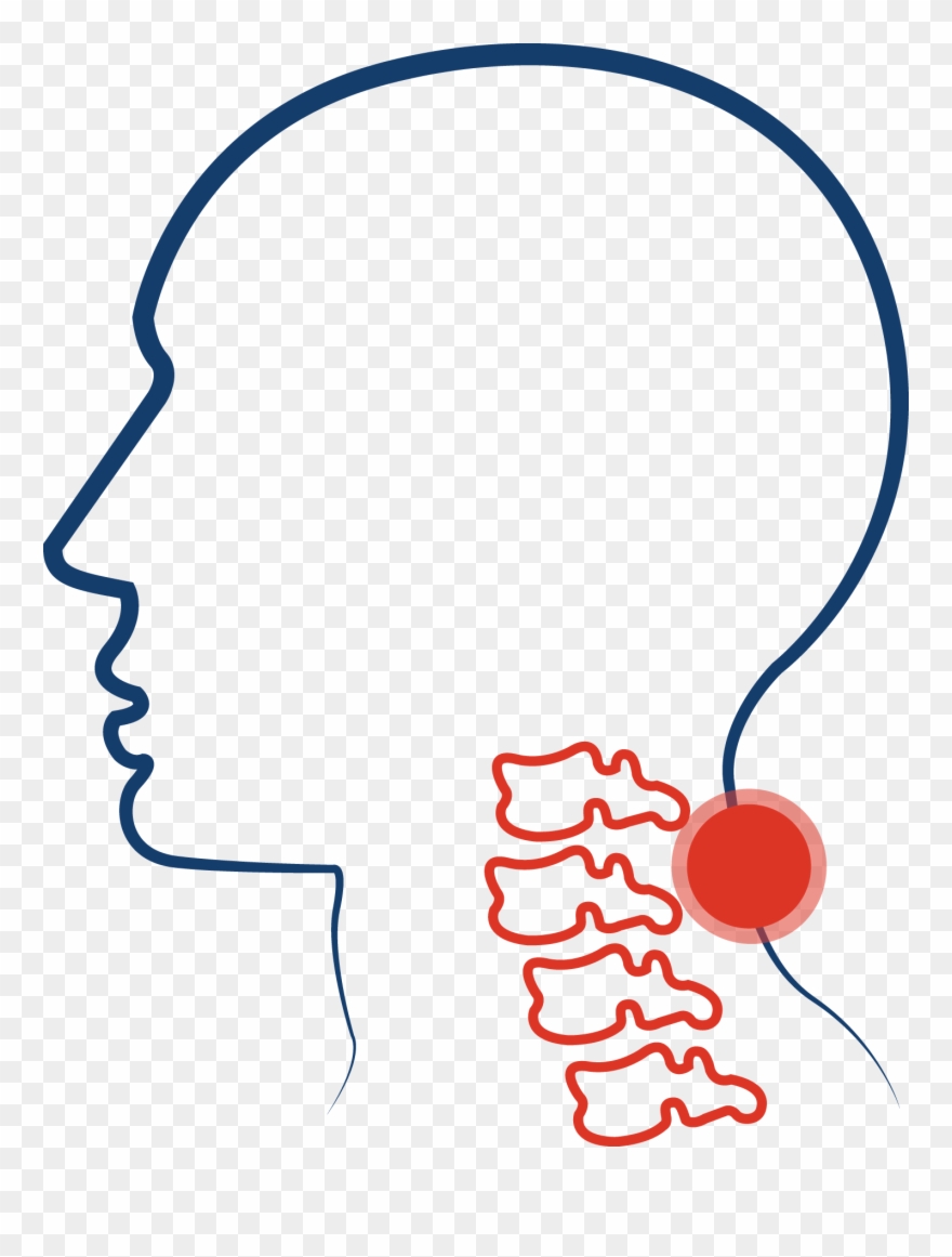Cervical Spinal Stenosis Clipart