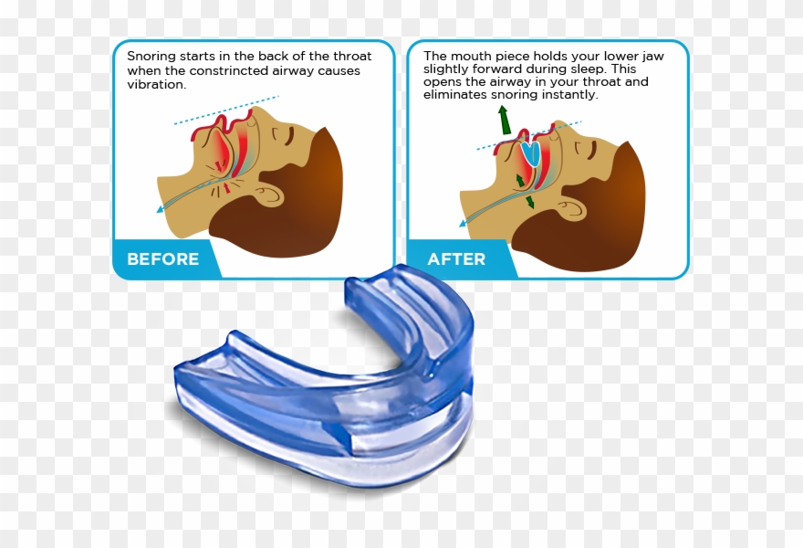 Person's Mouth While They Sleep - Snore Moldable Mouth Guard Stop Teeth Grinding Clipart
